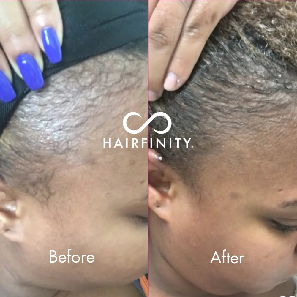Hair Infinity Growth Boosters kit edges huile et sérum